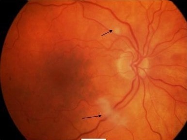 Oclusão aguda da artéria retiniana central