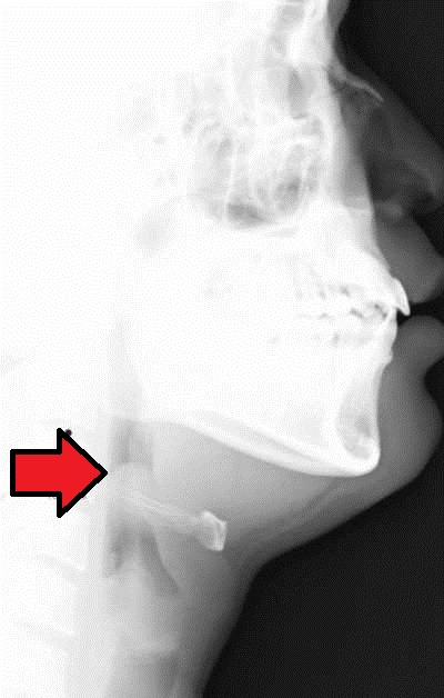 Acute epiglottitis on x-ray