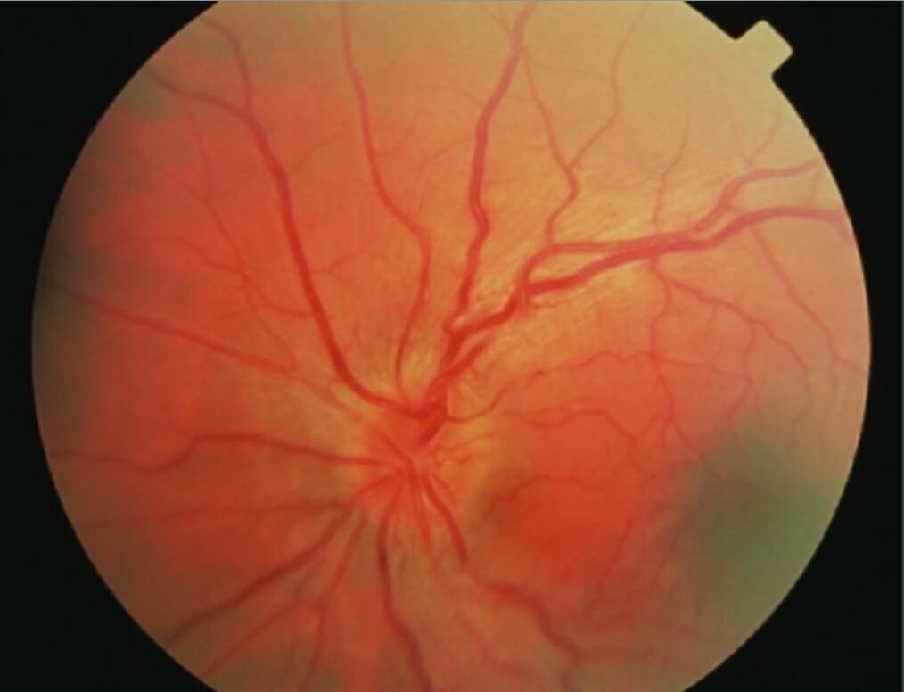 Acute fundal appearance in leber hereditary optic neuropathy
