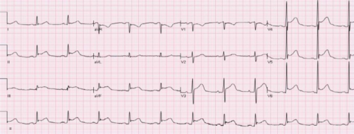 Ecg in acute pericarditis, showing diffuse upsloping