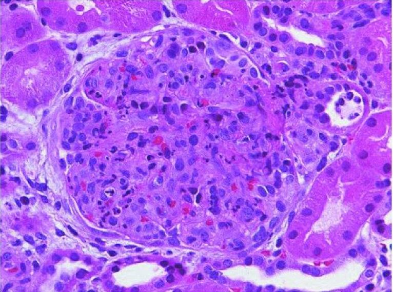 Glomerulonefrite pós-estreptocócica aguda