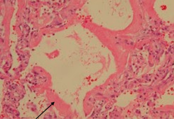 Oxido Nítrico inhalado en el Síndrome de Distrés Respiratorio