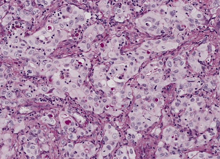 lung cancer histology