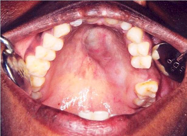 Adenoid cystic carcinoma of the palate