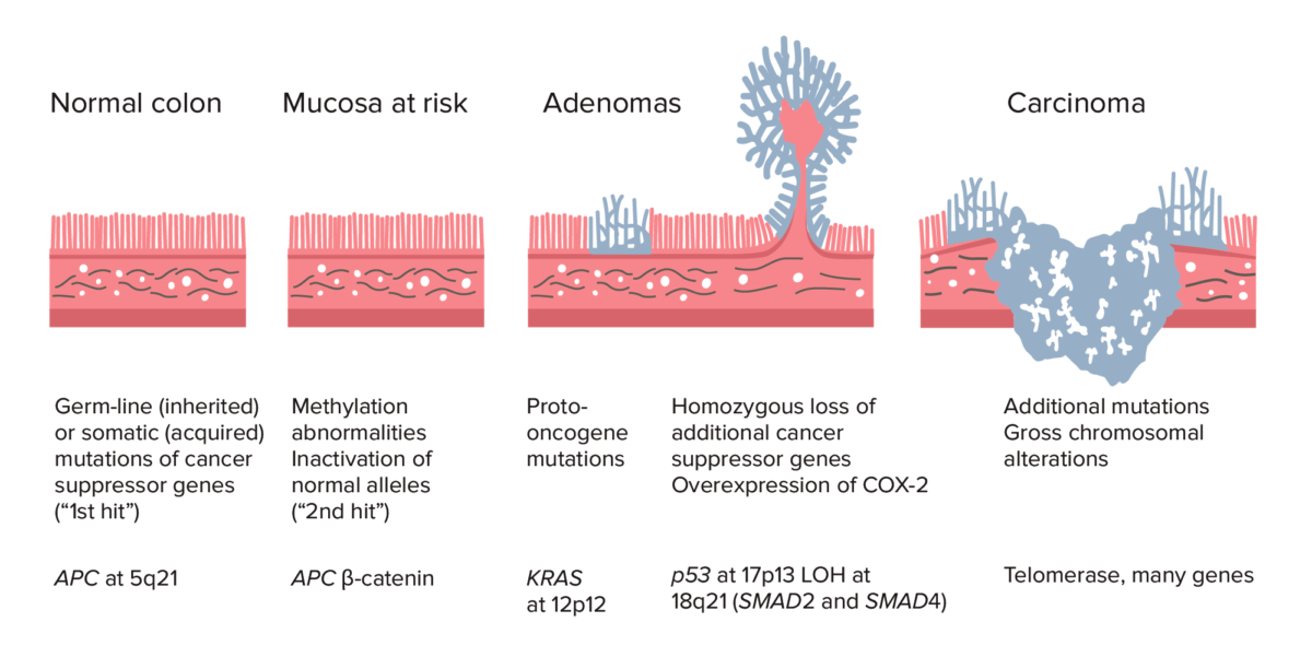 Adenoma-carcinoma sequence