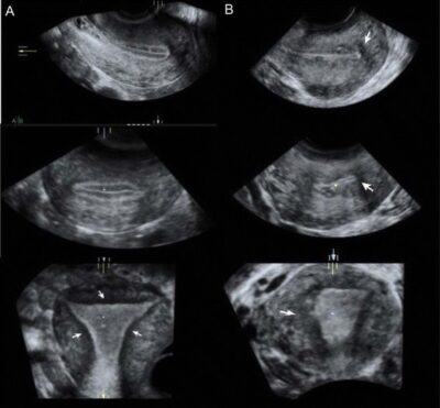 Adenomyosis | Concise Medical Knowledge