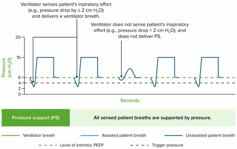 Invasive Mechanical Ventilation 