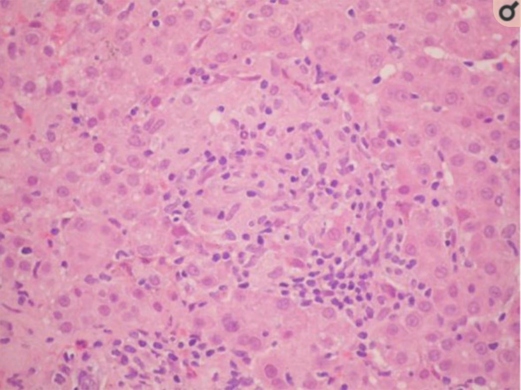 Albendazole-induced granulomatous hepatitis