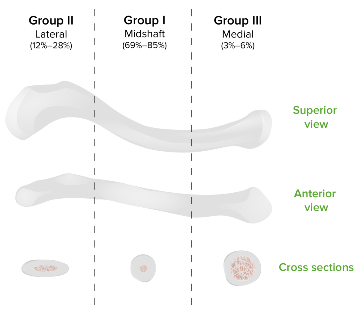 Classificação de fraturas de allman