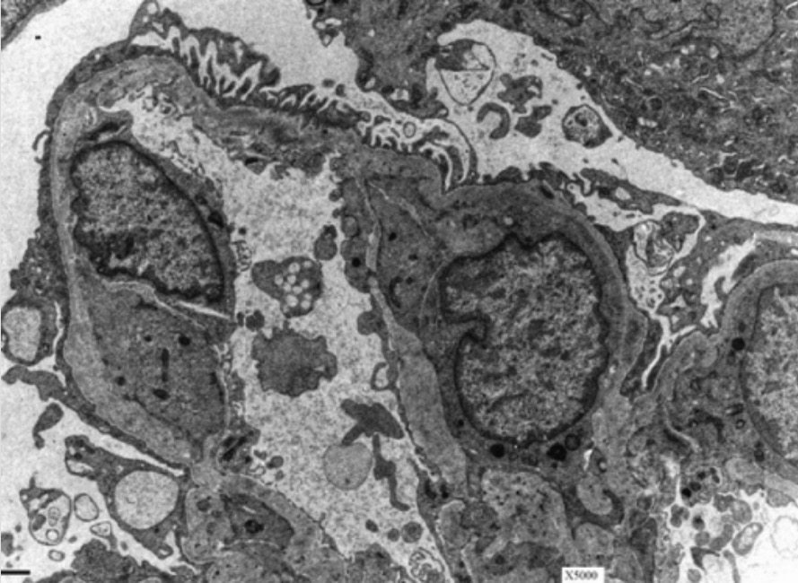 renal biopsy alport syndrome