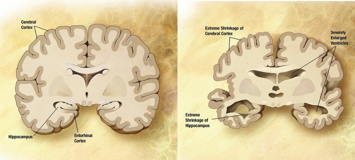 Alzheimer brain comparison