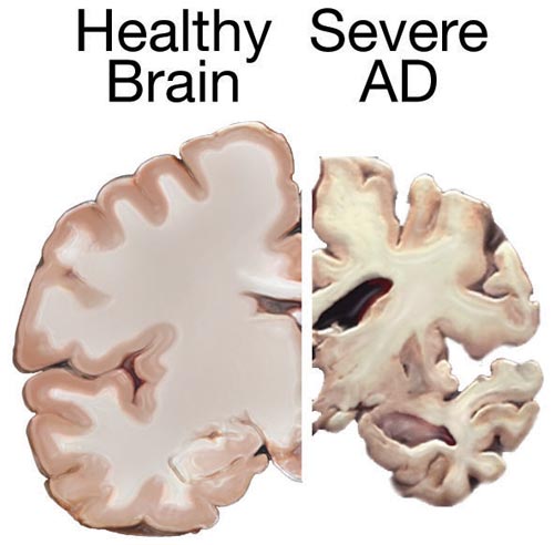 Alzheimer  Falha em estudo coloca em xeque a hipótese da placa amiloide -  Canaltech