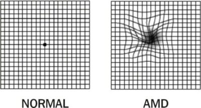 Macular Degeneration | Concise Medical Knowledge