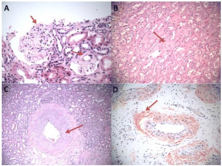 Amyloid deposits in the three major compartments of the kidney