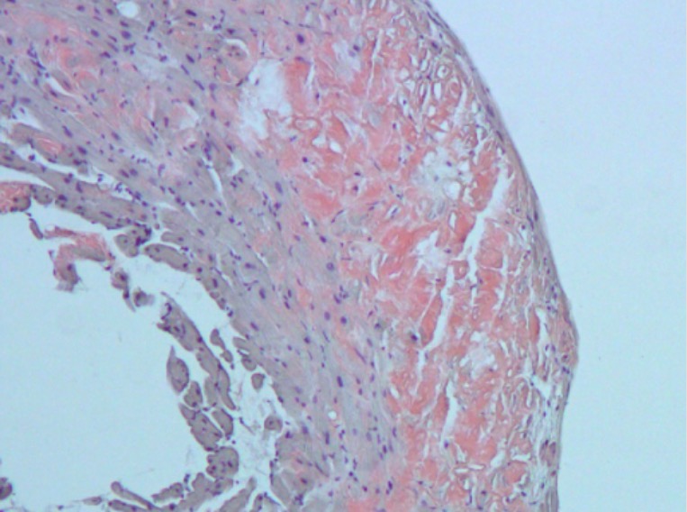 restrictive cardiomyopathy histology