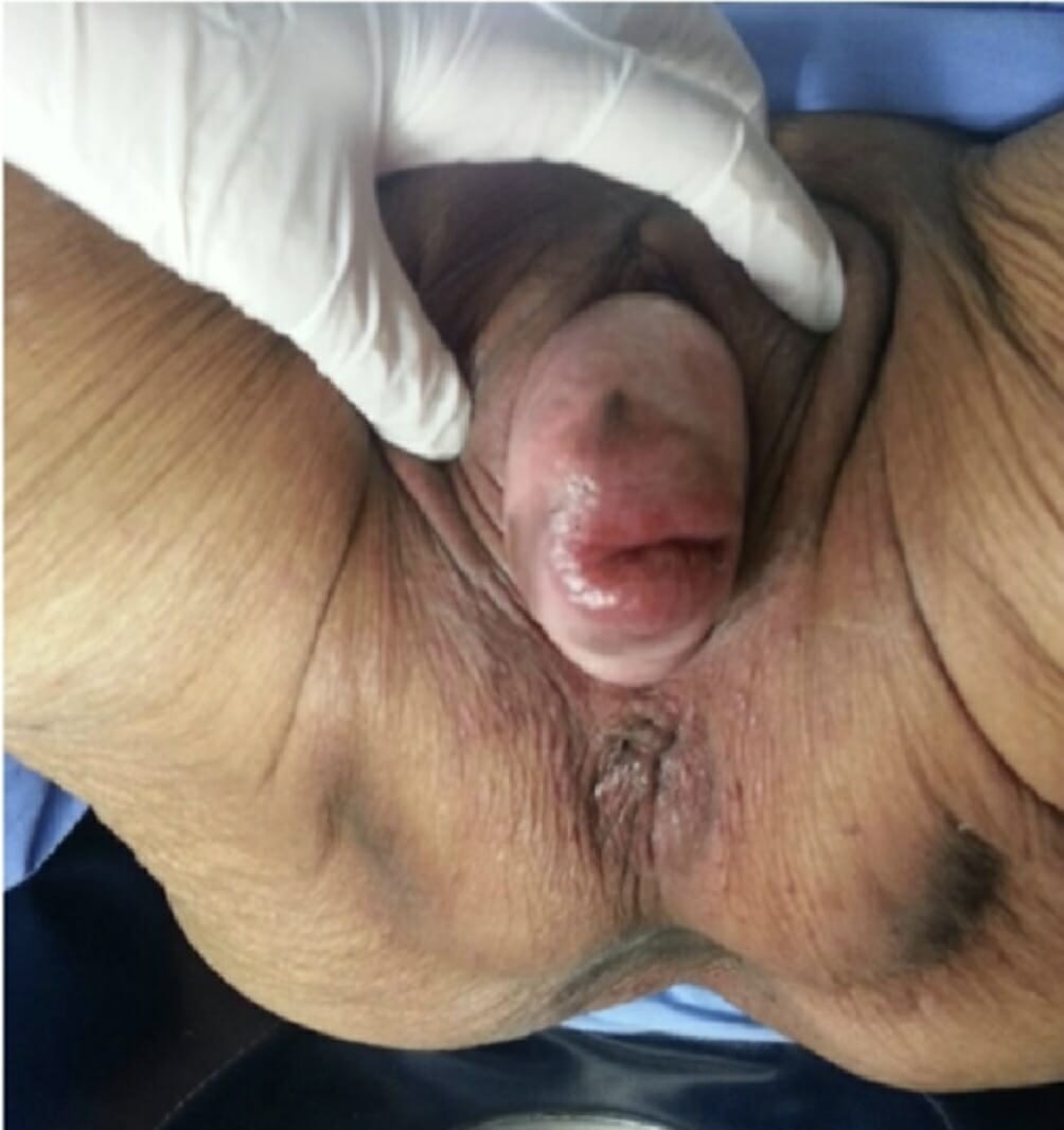 An 87-year-old woman with uterine prolapse stage iv