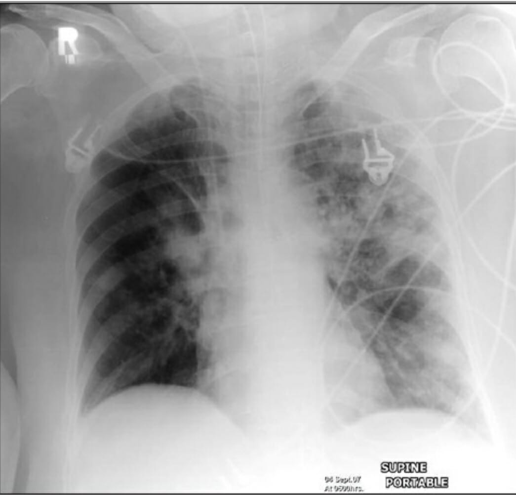 An ap supine radiograph of a patient on mechanical ventilation showing patchy consolidation in both lung fields (more prominent on the left) due to hospital-acquired pneumonia