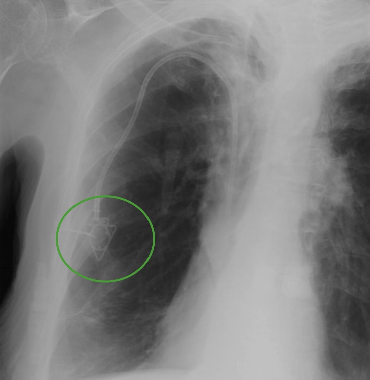 An x-ray of a patient with a port-a-cath