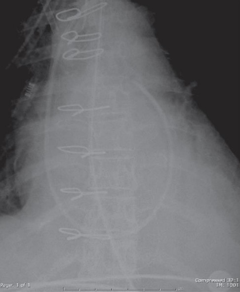 An x-ray of a patient with a swan-ganz catheter