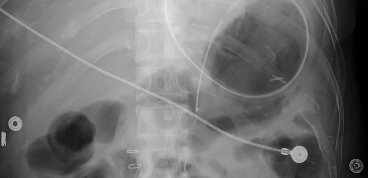 An x-ray of a patient with a nasogastric tube