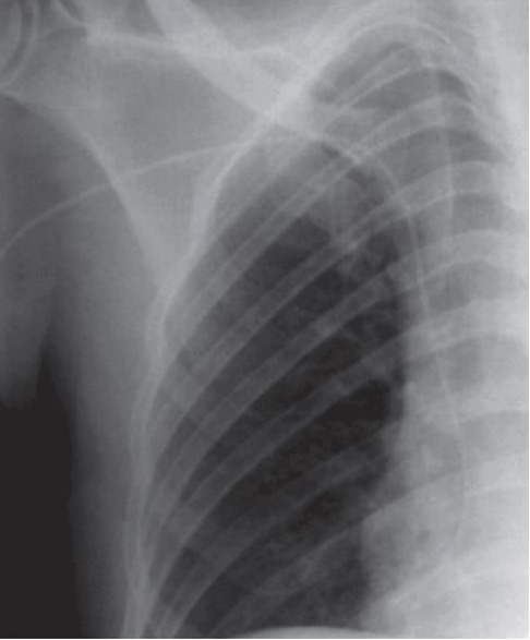 An x-ray of a patient with a peripherally inserted central catheter (picc)