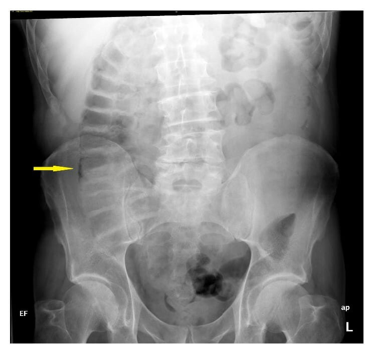 An abdominal x-ray showing pneumatosis intestinalis in the ascending colon