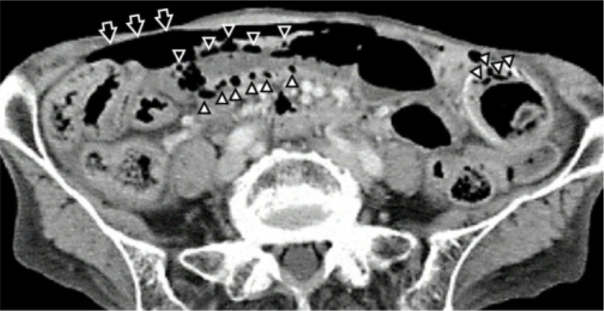 An abdominal computed tomography image demonstrating a large quantity of free air