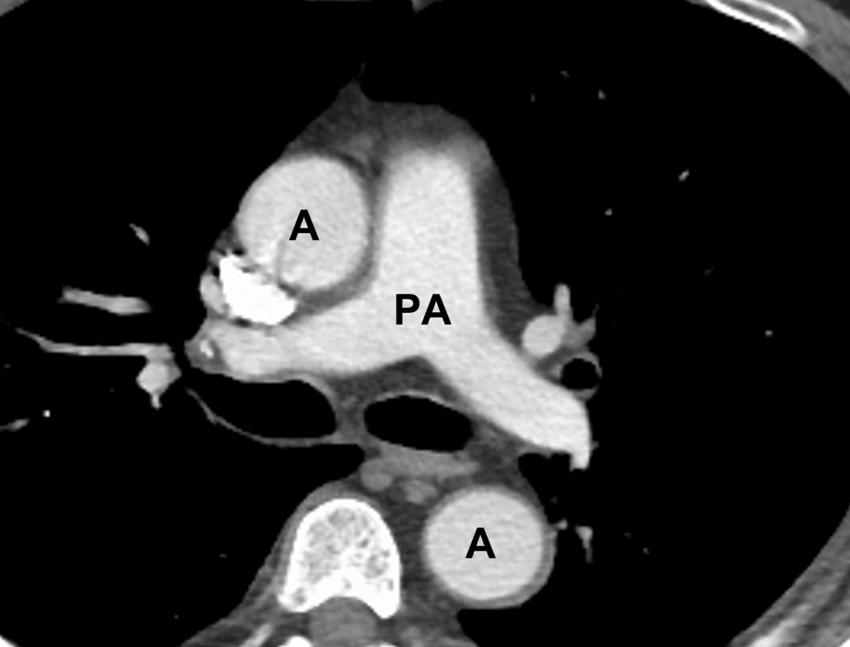 An axial cut of a chest ct scan visualizing the great vessels