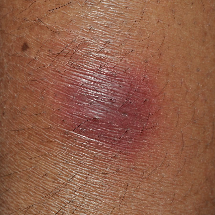 An individual with erythema nodosum due to chronic hepatitis c infection