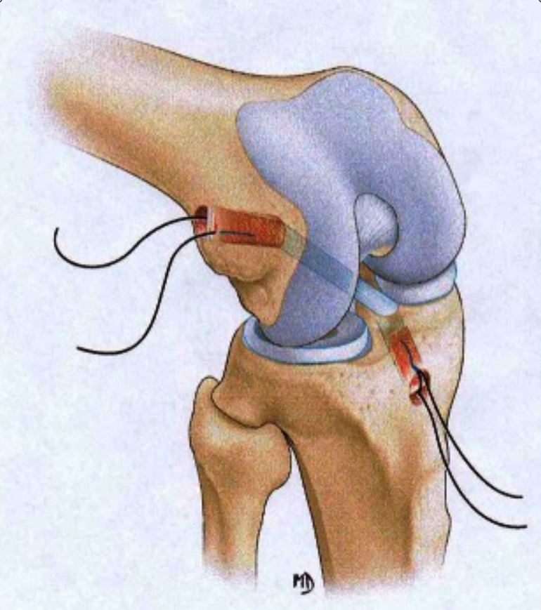 Knee Ligament Injuries Concise Medical Knowledge