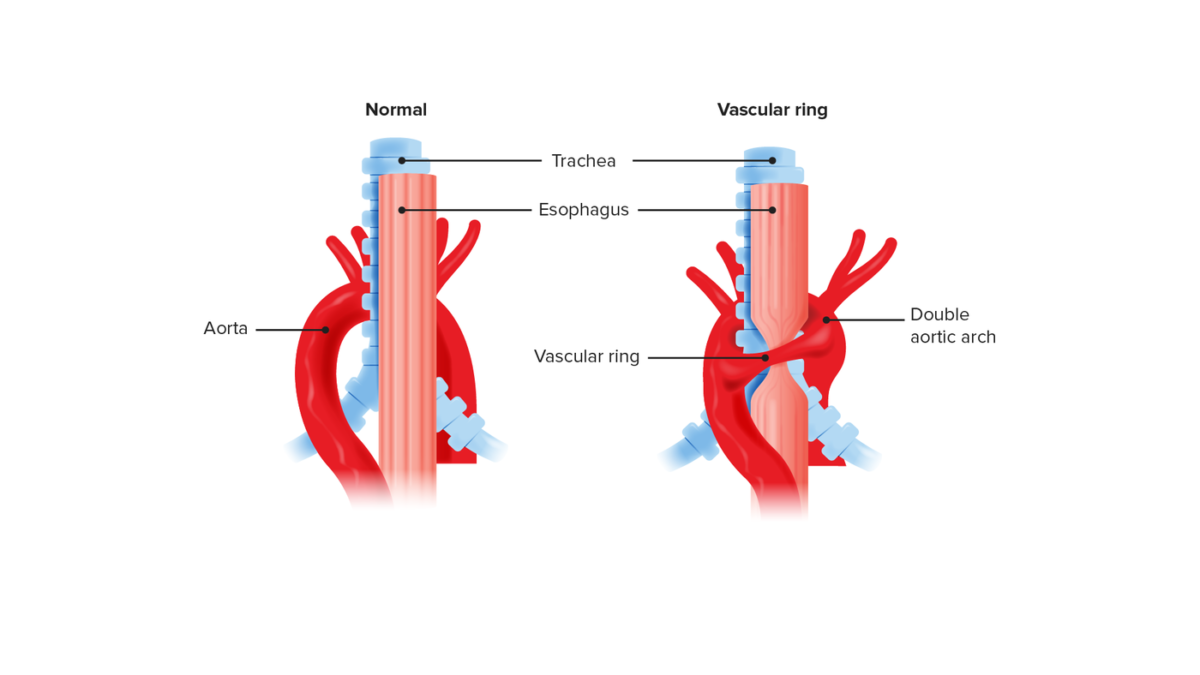 Vascular ring compared to normal anatomy