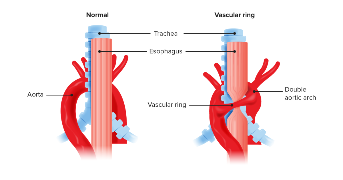 Anatomical recreation of a vascular ring compared to normal anatomy