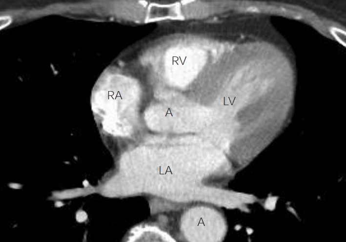 Anatomy of the heart on chest ct axial view