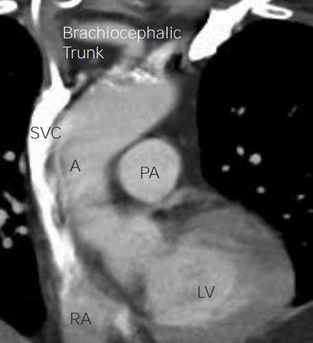 Anatomy of the heart on chest ct on coronal view
