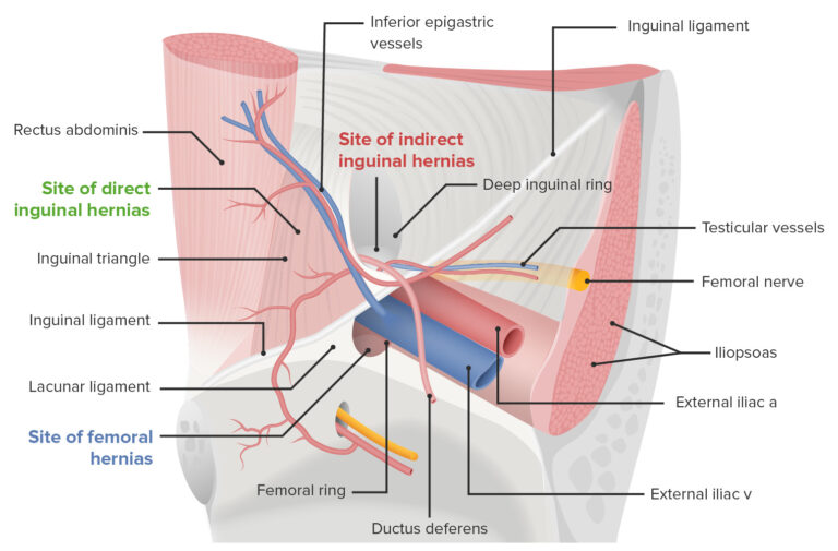 Abdominal Hernias | Concise Medical Knowledge