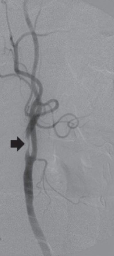 Angiogram of internal carotid artery stenosis