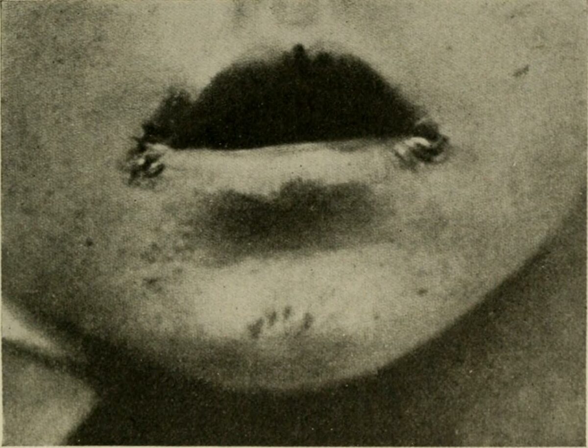Angular cheilitis in a child iron deficiency anemia