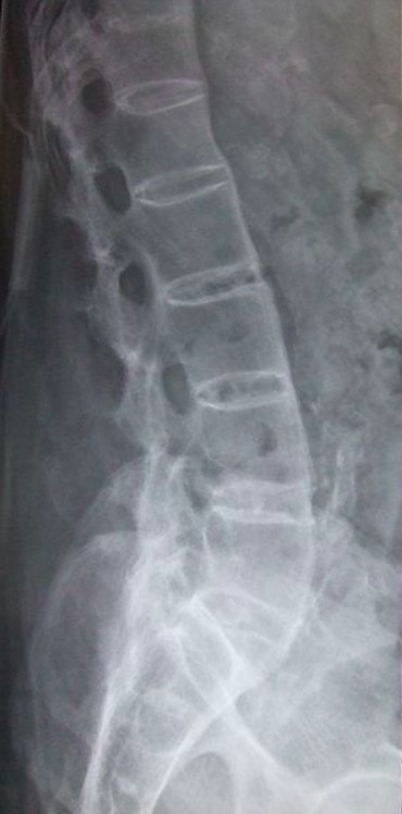 Ankylosing spondylitis lumbar spine