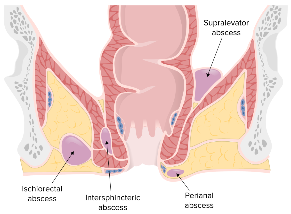 Localización de abscesos perianales, isquiorrectales, interesfinterianos y supraelevadores