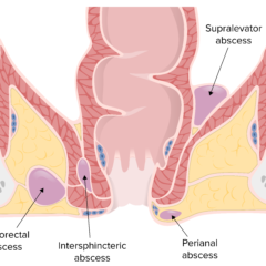 Locations of perianal, ischiorectal, intersphincteric, and supralevator abscesses