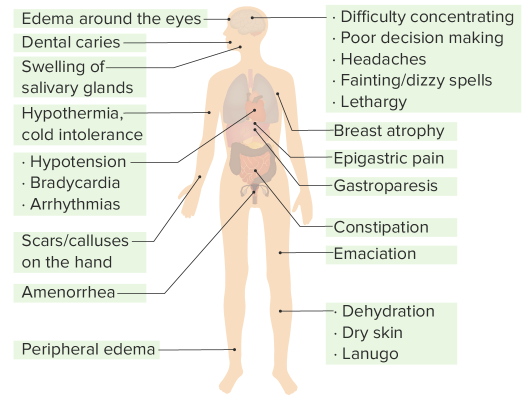 Anorexia signs and symptoms