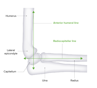 Supracondylar Fracture | Concise Medical Knowledge