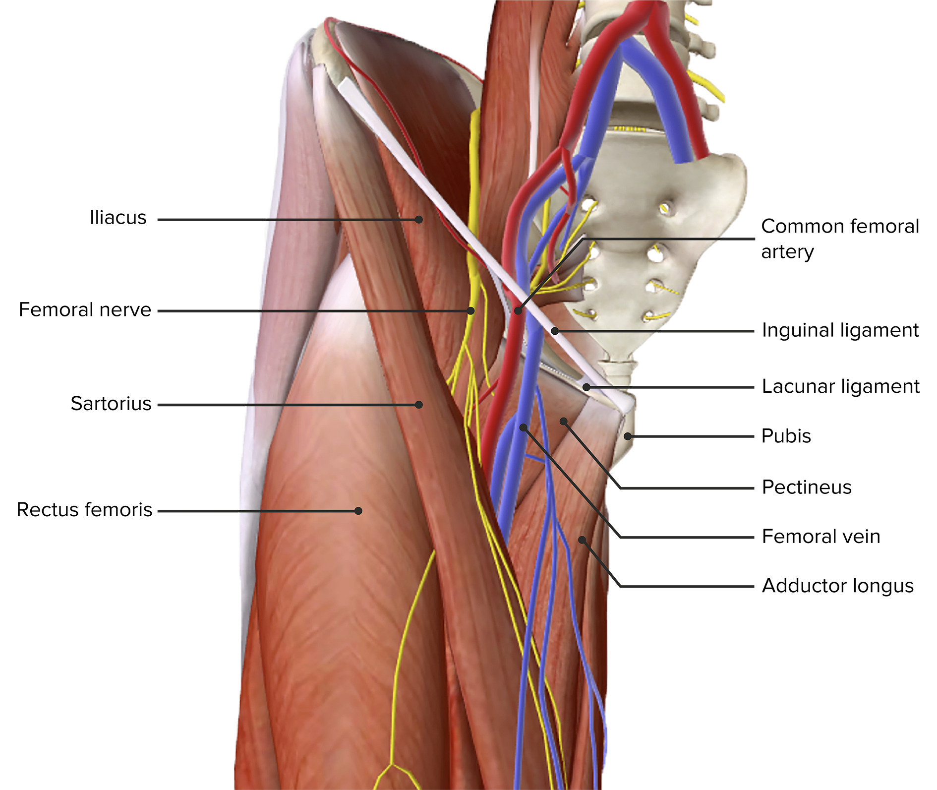 Open femoral hernia repair reveals a hernia sac containing a necrotic
