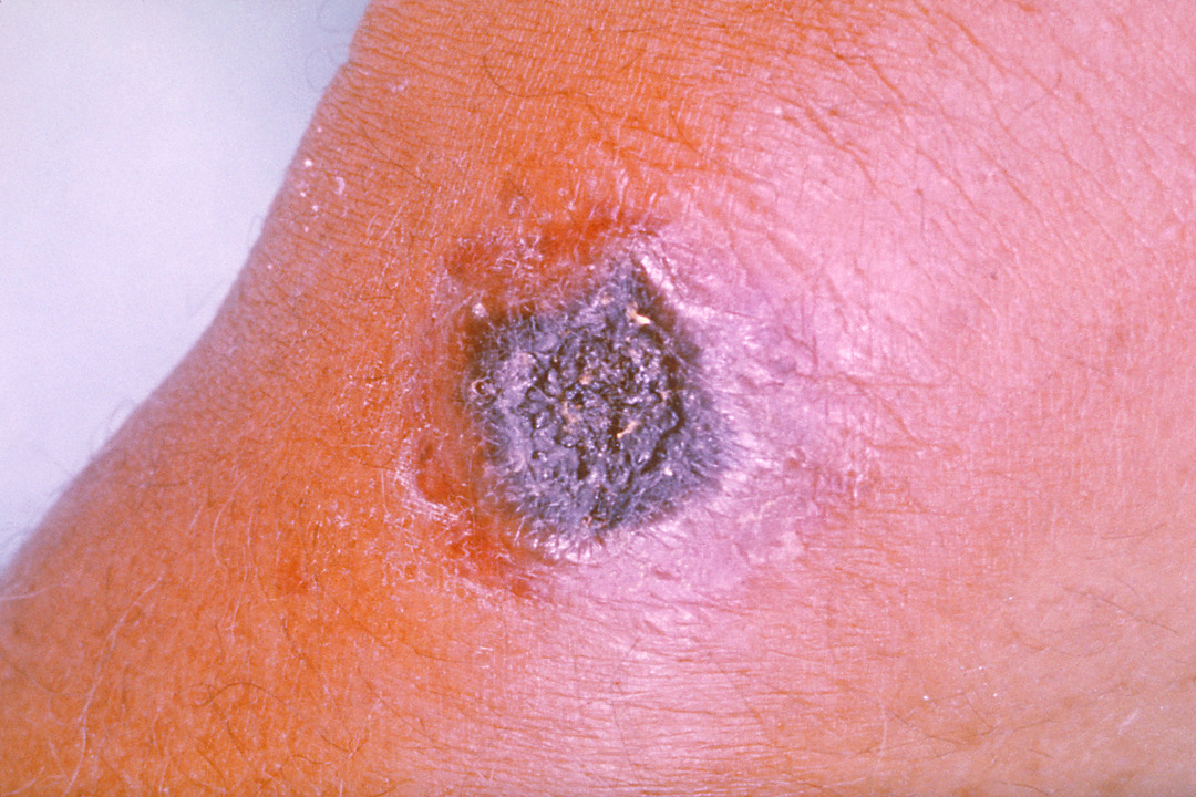 Skin lesion caused by anthrax