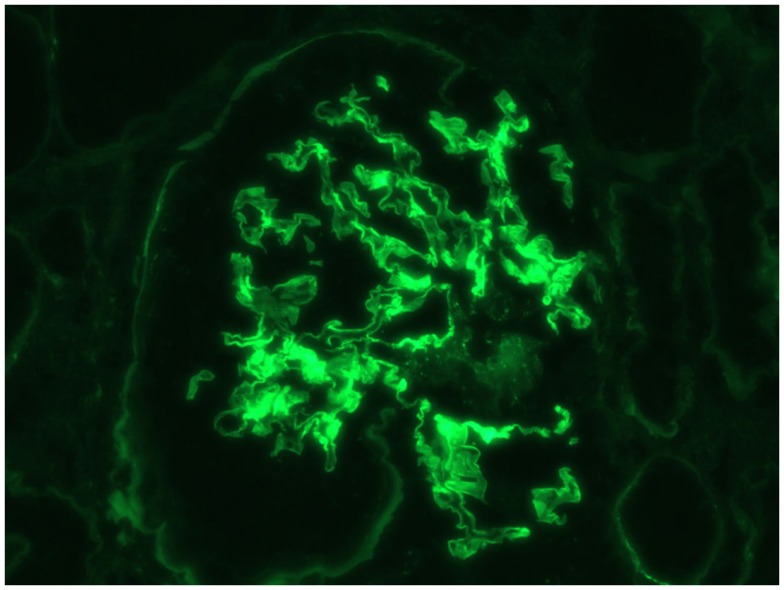 Anti-gbm antibody disease: immunofluorescence linear staining of igg