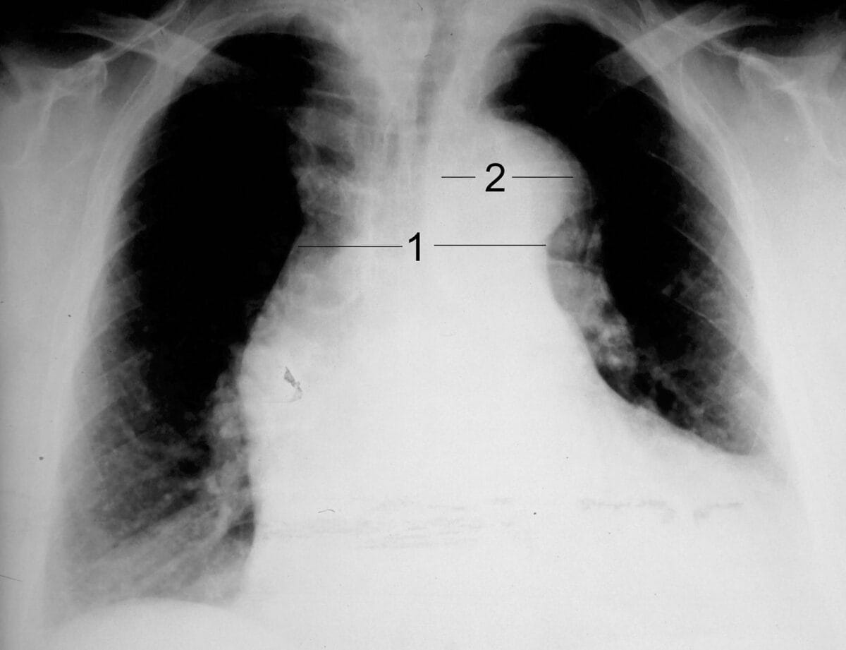 Aortic dissection xray