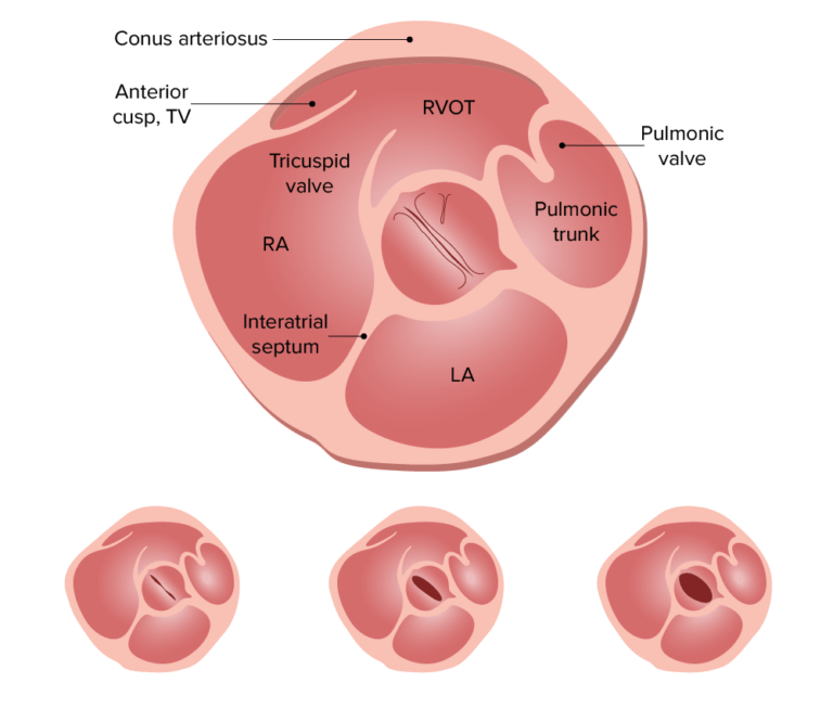 Estenosis Aórtica Concise Medical Knowledge