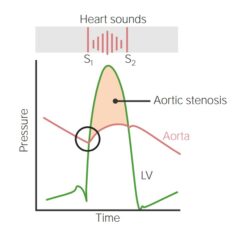 Aortic stenosis heart sounds