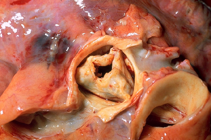 Aortic stenosis rheumatic