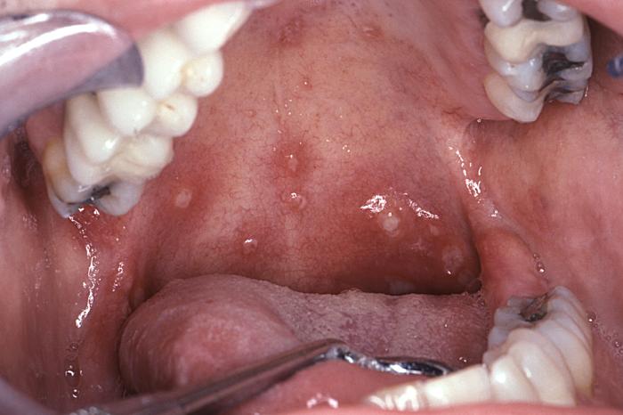 Aphthous stomatitis in acute retroviral syndrome